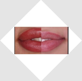 Lip before and after